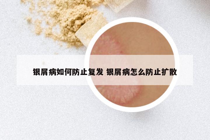 银屑病如何防止复发 银屑病怎么防止扩散