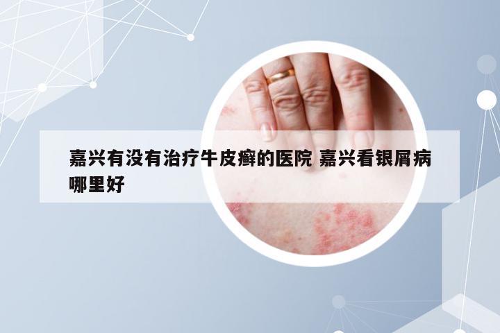 嘉兴有没有治疗牛皮癣的医院 嘉兴看银屑病哪里好