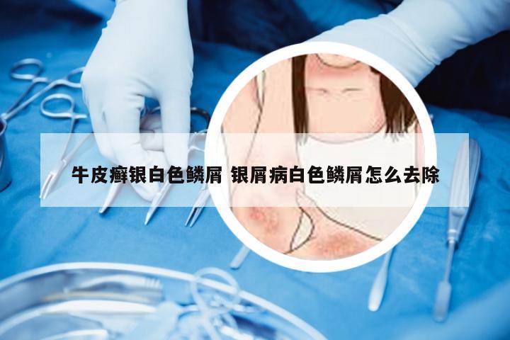 牛皮癣银白色鳞屑 银屑病白色鳞屑怎么去除