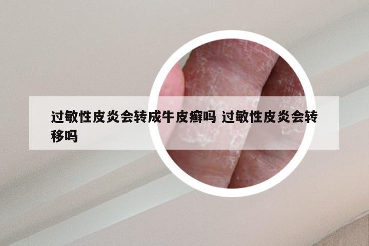 过敏性皮炎会转成牛皮癣吗 过敏性皮炎会转移吗
