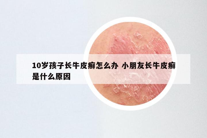 10岁孩子长牛皮癣怎么办 小朋友长牛皮癣是什么原因