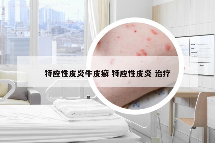 特应性皮炎牛皮癣 特应性皮炎 治疗
