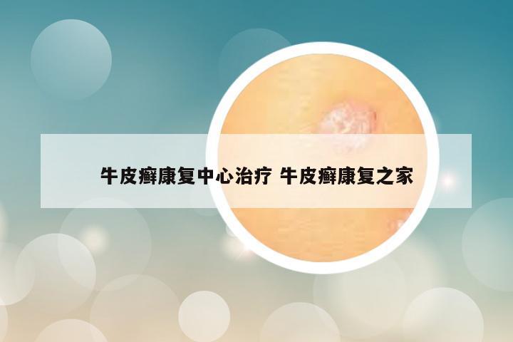 牛皮癣康复中心治疗 牛皮癣康复之家