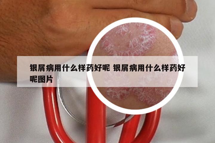 银屑病用什么样药好呢 银屑病用什么样药好呢图片