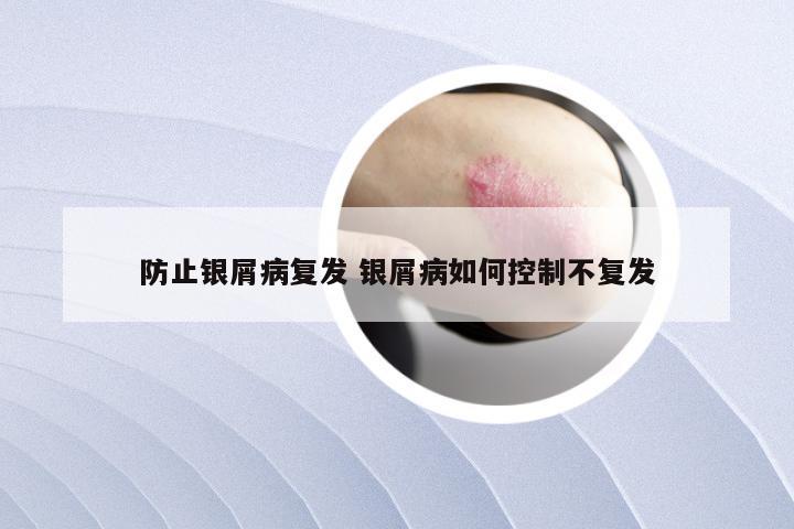 防止银屑病复发 银屑病如何控制不复发