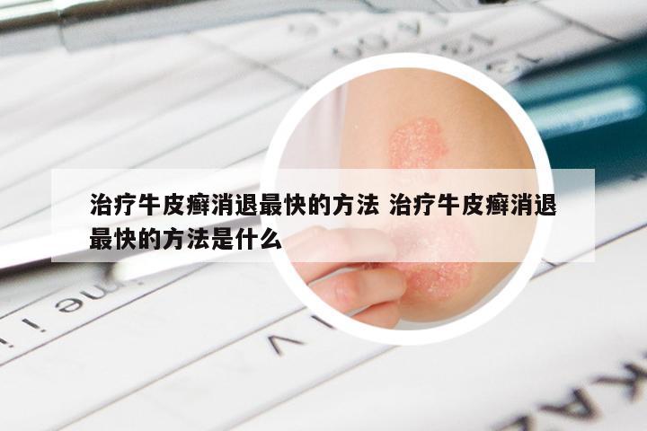 治疗牛皮癣消退最快的方法 治疗牛皮癣消退最快的方法是什么