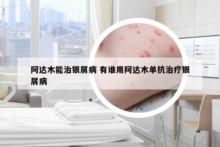 阿达木能治银屑病 有谁用阿达木单抗治疗银屑病