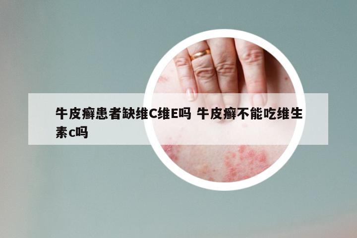 牛皮癣患者缺维C维E吗 牛皮癣不能吃维生素c吗