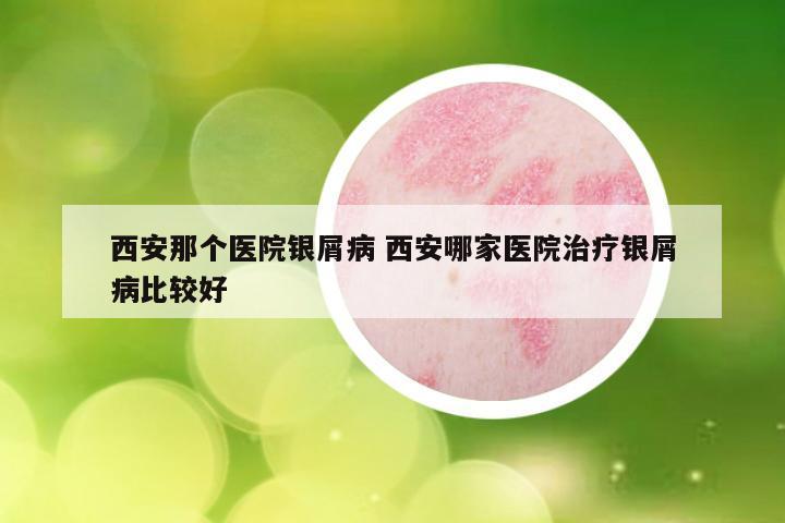西安那个医院银屑病 西安哪家医院治疗银屑病比较好