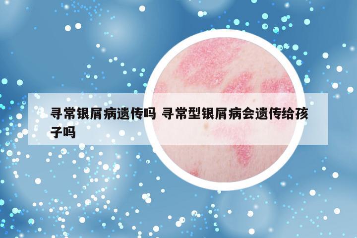 寻常银屑病遗传吗 寻常型银屑病会遗传给孩子吗