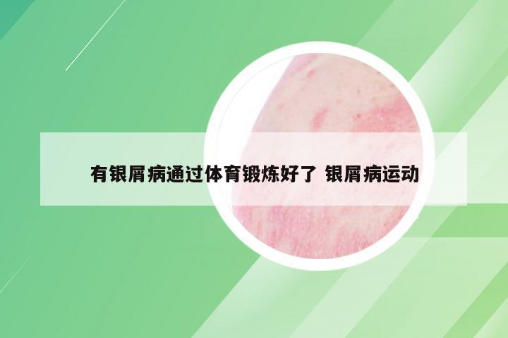 有银屑病通过体育锻炼好了 银屑病运动