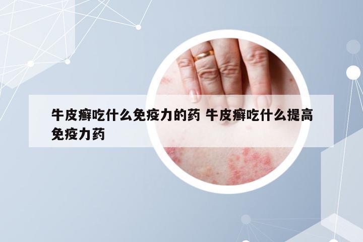 牛皮癣吃什么免疫力的药 牛皮癣吃什么提高免疫力药