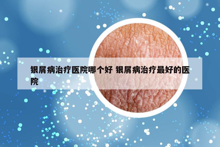 银屑病治疗医院哪个好 银屑病治疗最好的医院
