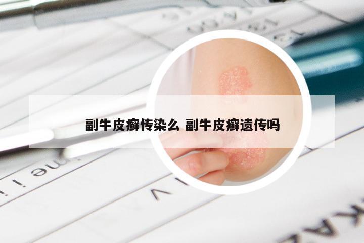 副牛皮癣传染么 副牛皮癣遗传吗