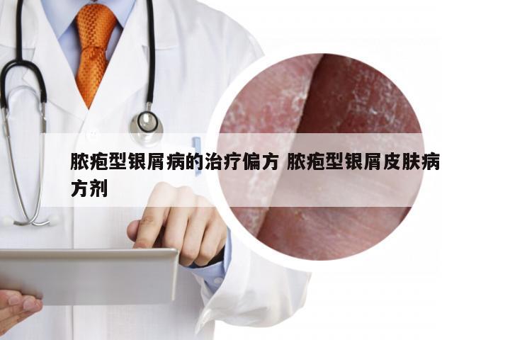 脓疱型银屑病的治疗偏方 脓疱型银屑皮肤病方剂