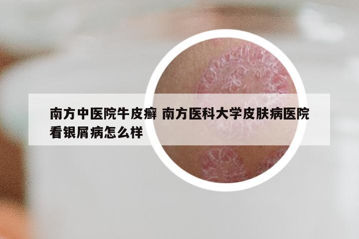 南方中医院牛皮癣 南方医科大学皮肤病医院看银屑病怎么样