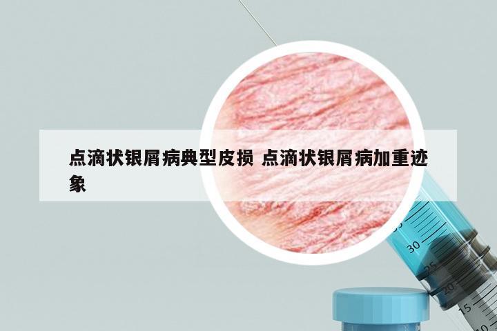 点滴状银屑病典型皮损 点滴状银屑病加重迹象