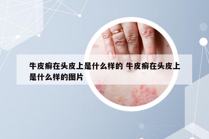 牛皮癣在头皮上是什么样的 牛皮癣在头皮上是什么样的图片