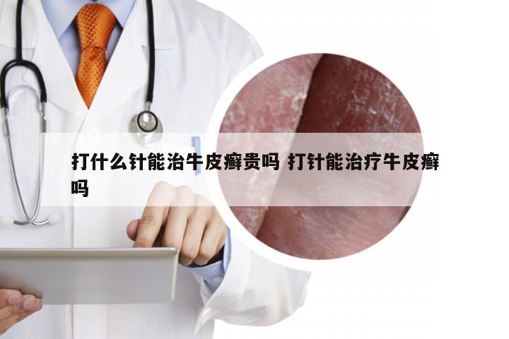 打什么针能治牛皮癣贵吗 打针能治疗牛皮癣吗