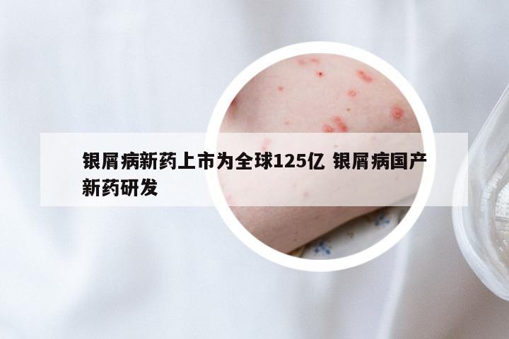 银屑病新药上市为全球125亿 银屑病国产新药研发
