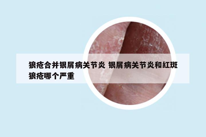 狼疮合并银屑病关节炎 银屑病关节炎和红斑狼疮哪个严重