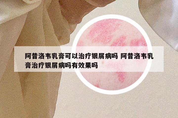 阿昔洛韦乳膏可以治疗银屑病吗 阿昔洛韦乳膏治疗银屑病吗有效果吗
