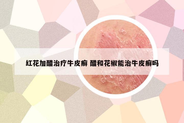 红花加醋治疗牛皮癣 醋和花椒能治牛皮癣吗