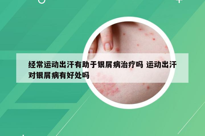 经常运动出汗有助于银屑病治疗吗 运动出汗对银屑病有好处吗
