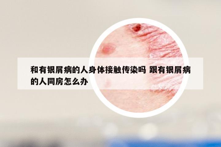 和有银屑病的人身体接触传染吗 跟有银屑病的人同房怎么办