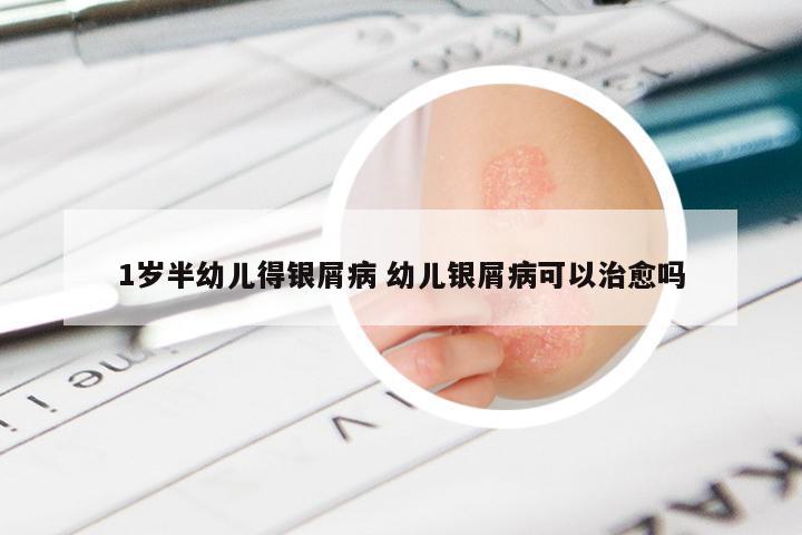 1岁半幼儿得银屑病 幼儿银屑病可以治愈吗