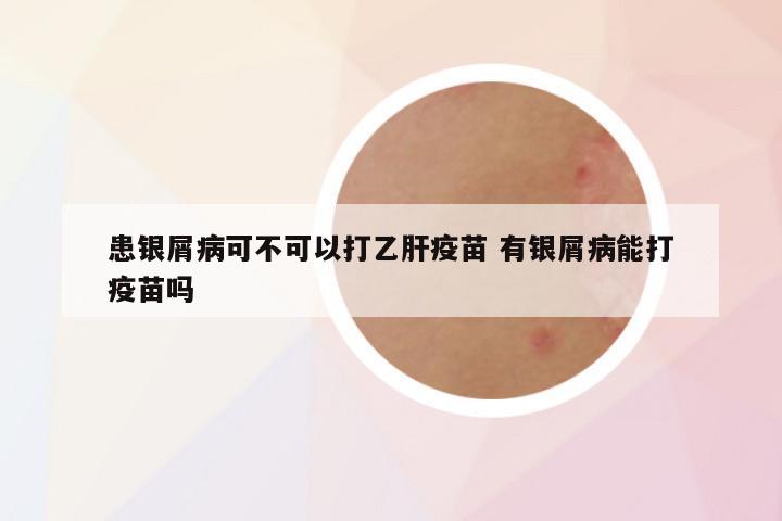患银屑病可不可以打乙肝疫苗 有银屑病能打疫苗吗