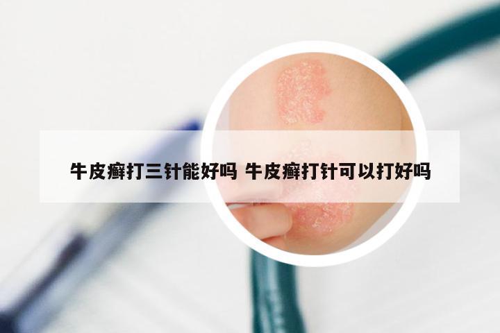 牛皮癣打三针能好吗 牛皮癣打针可以打好吗
