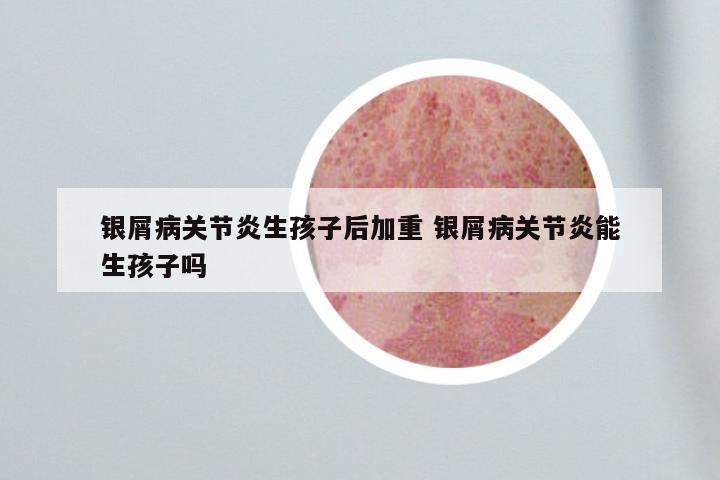 银屑病关节炎生孩子后加重 银屑病关节炎能生孩子吗
