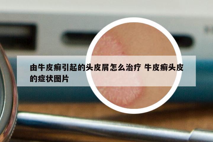 由牛皮癣引起的头皮屑怎么治疗 牛皮癣头皮的症状图片