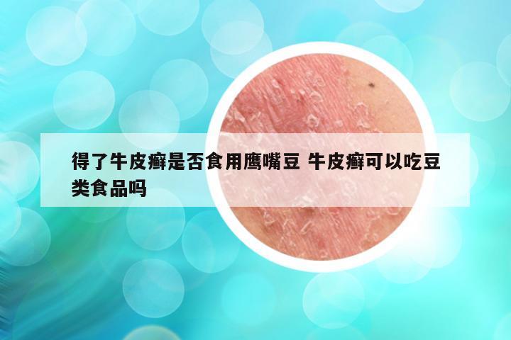 得了牛皮癣是否食用鹰嘴豆 牛皮癣可以吃豆类食品吗