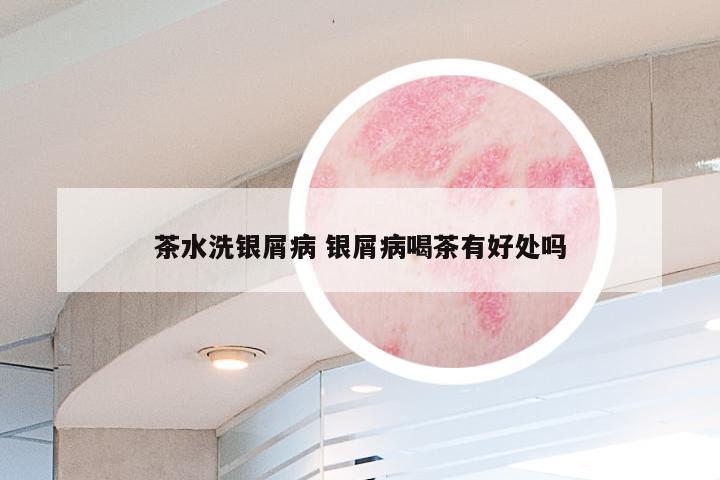 茶水洗银屑病 银屑病喝茶有好处吗