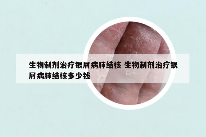 生物制剂治疗银屑病肺结核 生物制剂治疗银屑病肺结核多少钱