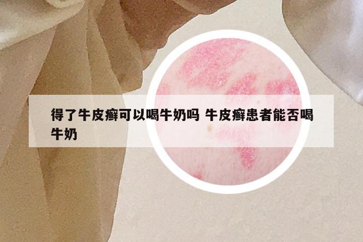 得了牛皮癣可以喝牛奶吗 牛皮癣患者能否喝牛奶