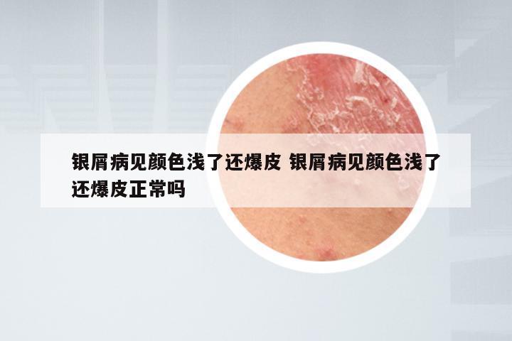 银屑病见颜色浅了还爆皮 银屑病见颜色浅了还爆皮正常吗