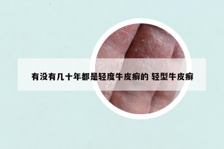 有没有几十年都是轻度牛皮癣的 轻型牛皮癣