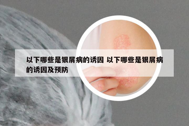 以下哪些是银屑病的诱因 以下哪些是银屑病的诱因及预防