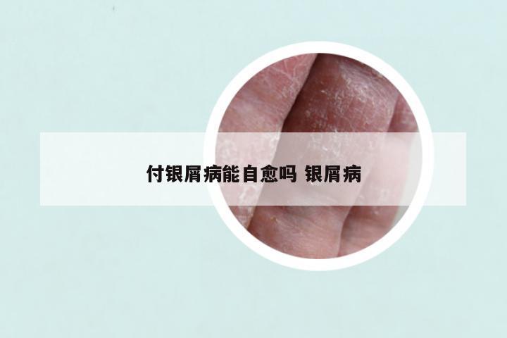 付银屑病能自愈吗 银屑病