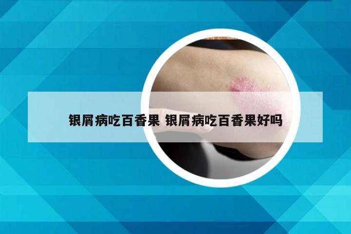 银屑病吃百香果 银屑病吃百香果好吗