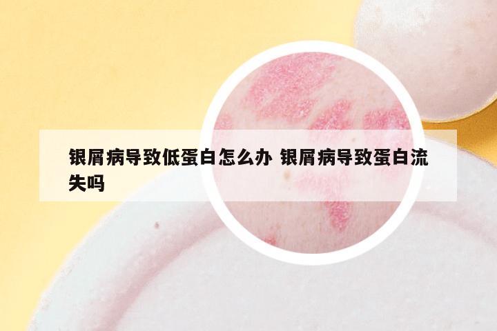 银屑病导致低蛋白怎么办 银屑病导致蛋白流失吗