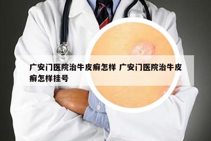 广安门医院治牛皮癣怎样 广安门医院治牛皮癣怎样挂号
