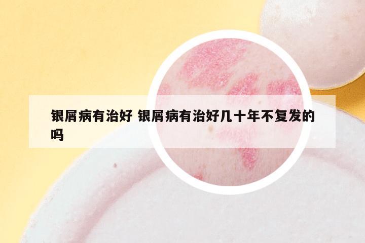 银屑病有治好 银屑病有治好几十年不复发的吗