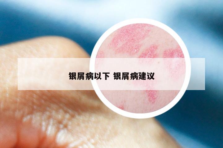 银屑病以下 银屑病建议