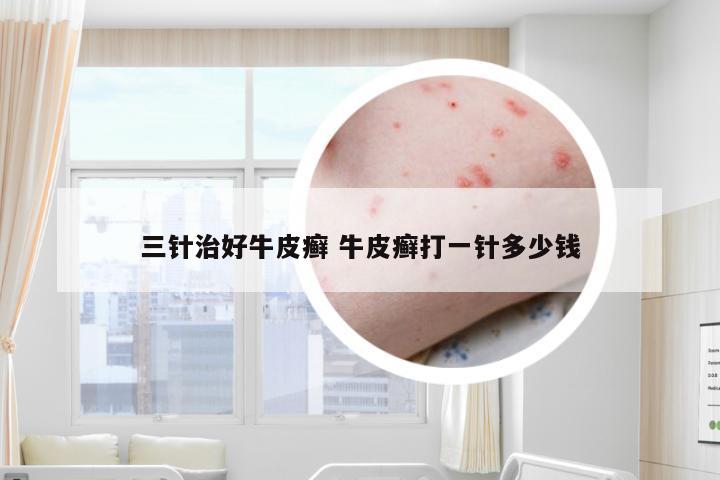 三针治好牛皮癣 牛皮癣打一针多少钱