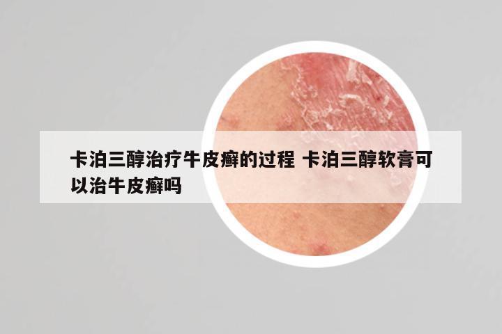 卡泊三醇治疗牛皮癣的过程 卡泊三醇软膏可以治牛皮癣吗