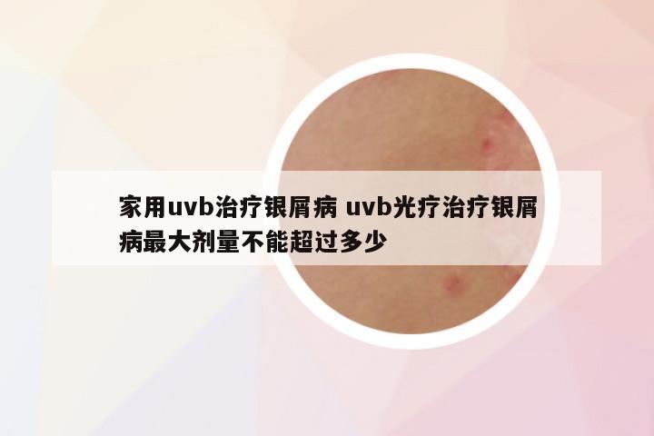 家用uvb治疗银屑病 uvb光疗治疗银屑病最大剂量不能超过多少